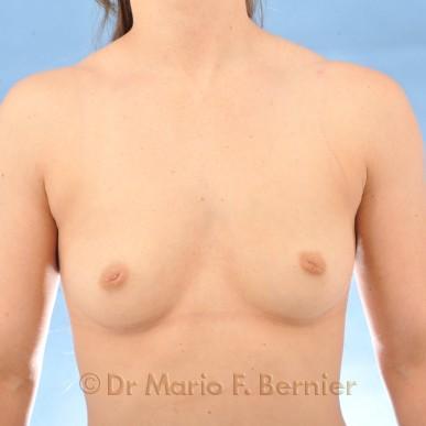 augmentation mammaire et correction des mamelons inversés - Avant